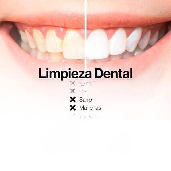 Blanqueador dental instantáneo™ - 🔥 El secreto para una sonrisa más limpia y atractiva