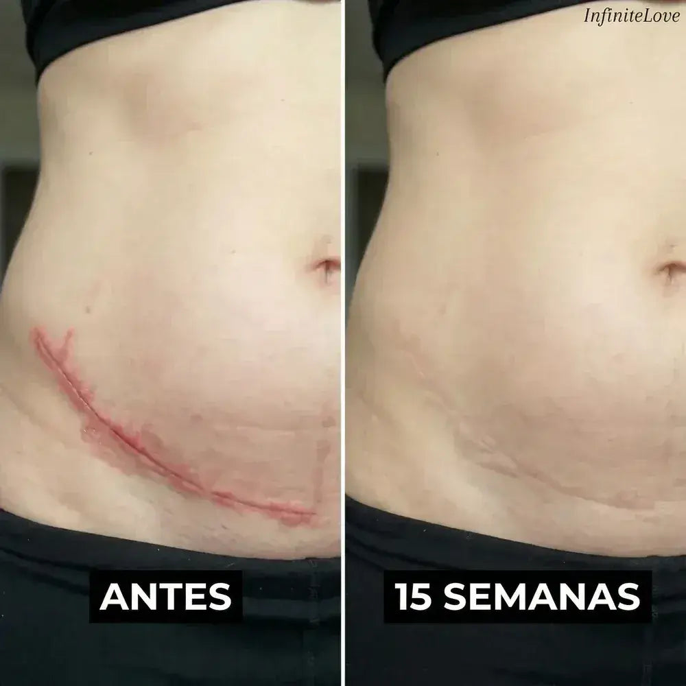 Crema Reparadora de Cicatrices con Silicona Médica – Suaviza y Reduce Marcas Visibles