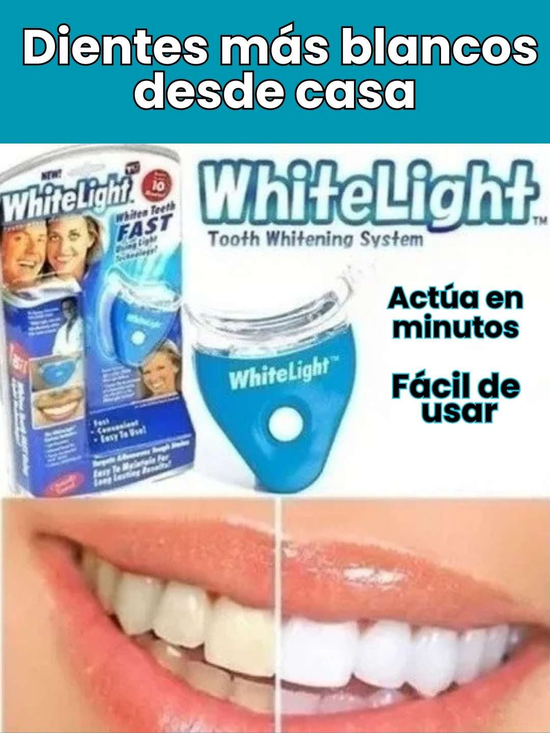 Blanqueamiento Profesional Dental en CASA Premium ™ .- ✨ Recupera una sonrisa más blanca sin gastar en el dentista